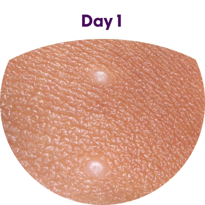 Photograph of molluscum contagiosum bumps on skin the day after the first treatment