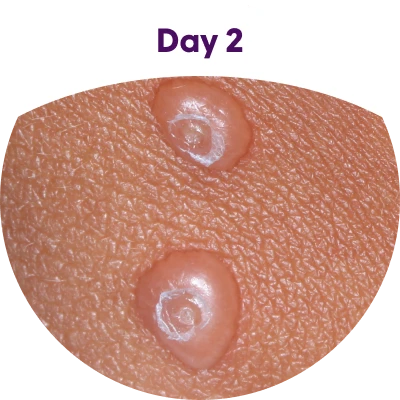 Image of molluscum bumps on the day after the first treatment